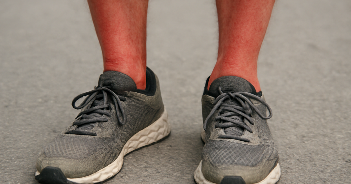 pieds rouges dans baskets apres course